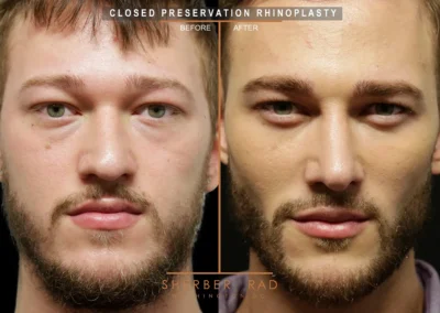Facial Optimization before and after photos by Sherber and Rad in Washington DC