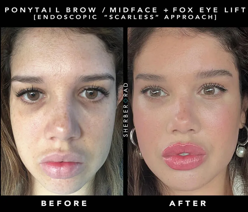 ethnic facelift before and after results