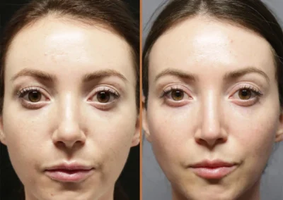 preservation rhinoplasty before and after photos by sherber and rad in washington dc