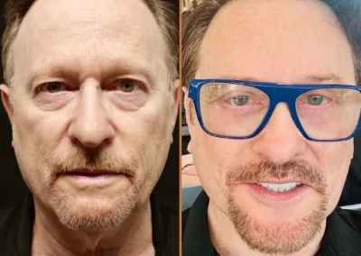 Male Facelift before and after photos by Sherber and Rad in Washington DC