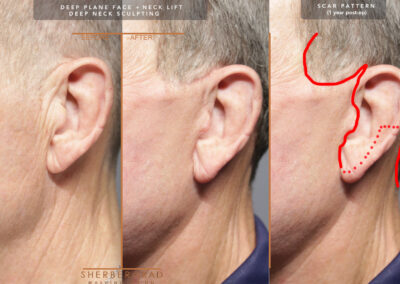 Male Facelift before and after photos by Sherber and Rad in Washington DC
