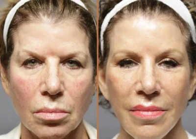 Deep Plane Facelift before and after photos by Sherber and Rad in Washington