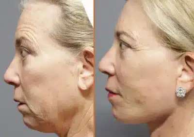 Deep Plane Facelift before and after photos by Sherber and Rad in Washington