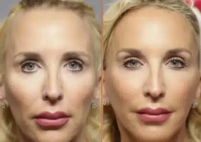 Deep Plane Facelift before and after photos by Sherber and Rad in Washington