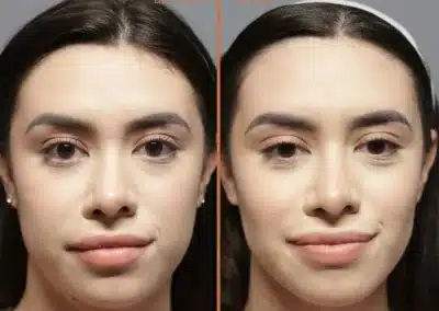 Deep Plane Neck lift before and after photos by Sherber and Rad in Washington