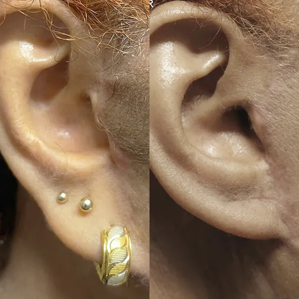 Earlobe Repair before and after photos by Sherber and Rad in Washington DC