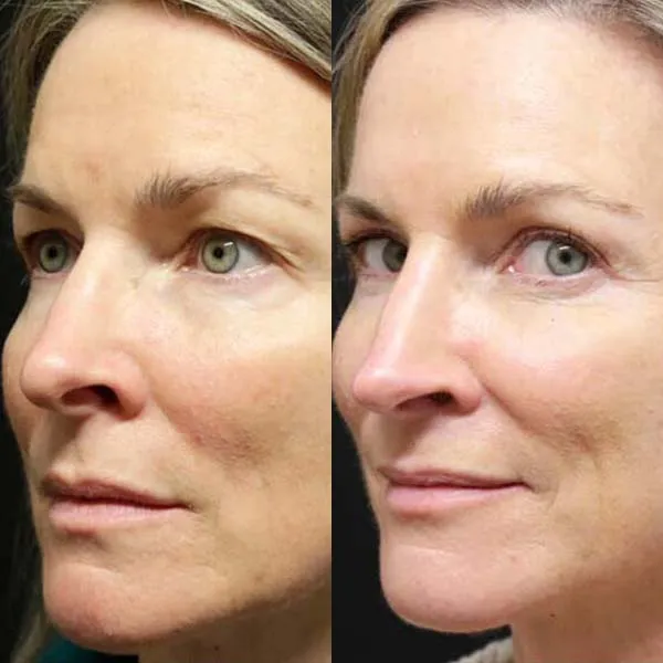 Upper Blepharoplasty before and after photos by Sherber and Rad in Washington DC