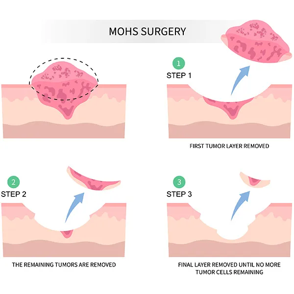 mohs surgery