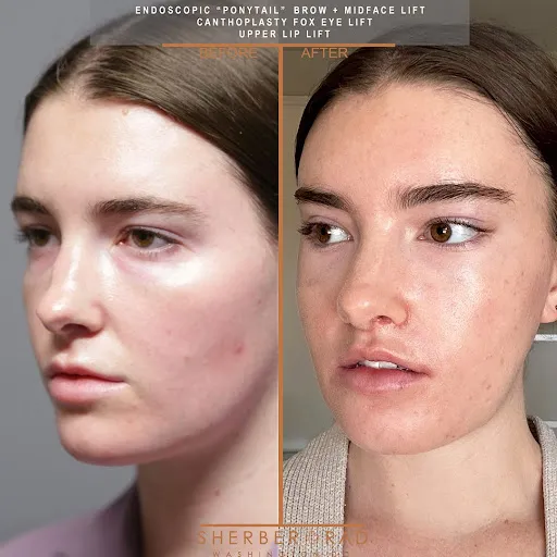 upper lip lift before and after