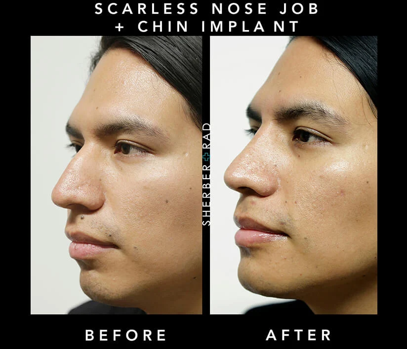Chin Augmentation before and after photos by Sherber and Rad in Washington, DC Chin Augmentation before and after photos by Sherber and Rad in Washington, DC