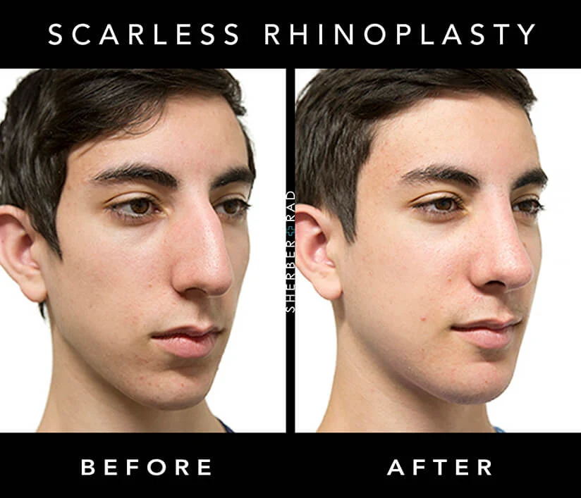 Chin Augmentation before and after photos by Sherber and Rad in Washington, DC Chin Augmentation before and after photos by Sherber and Rad in Washington, DC