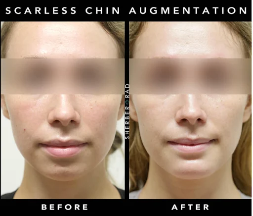 Chin Augmentation before and after photos by Sherber and Rad in Washington, DC