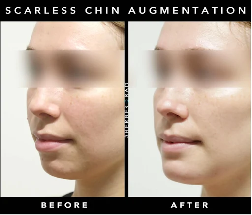 Chin Augmentation before and after photos by Sherber and Rad in Washington, DC