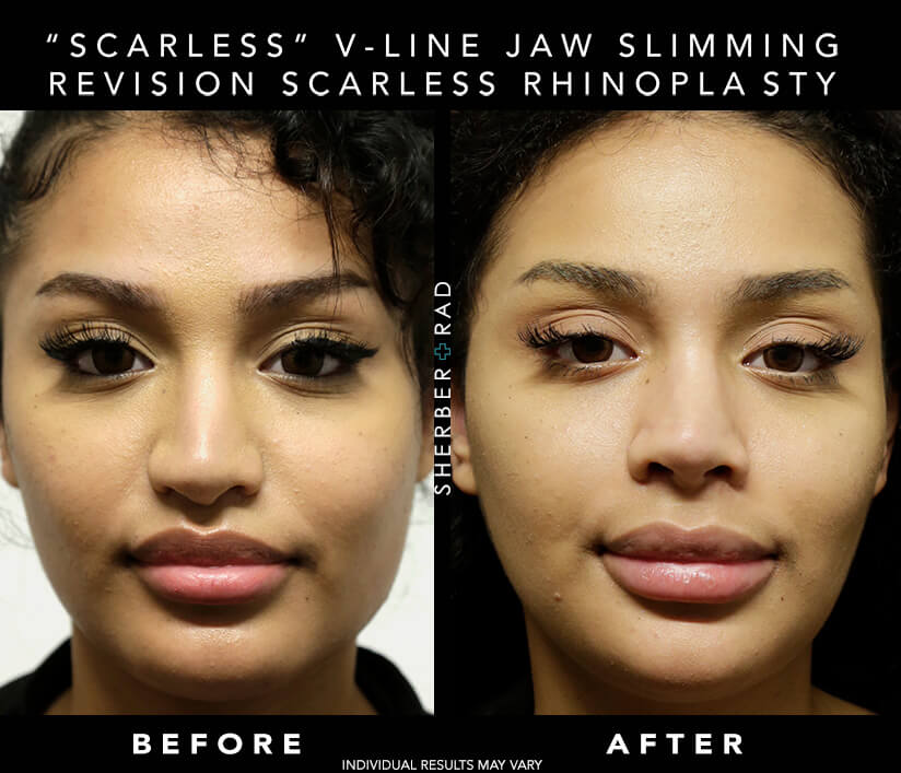 Chin Augmentation before and after photos by Sherber and Rad in Washington, DC Chin Augmentation before and after photos by Sherber and Rad in Washington, DC