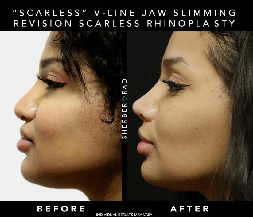 Chin Augmentation before and after photos by Sherber and Rad in Washington, DC Chin Augmentation before and after photos by Sherber and Rad in Washington, DC