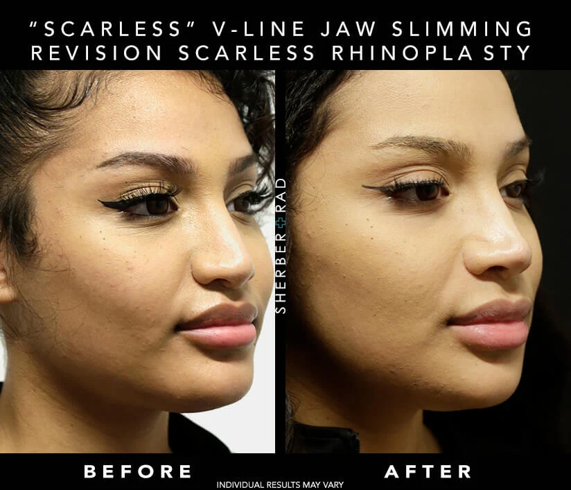 Chin Augmentation before and after photos by Sherber and Rad in Washington, DC Chin Augmentation before and after photos by Sherber and Rad in Washington, DC