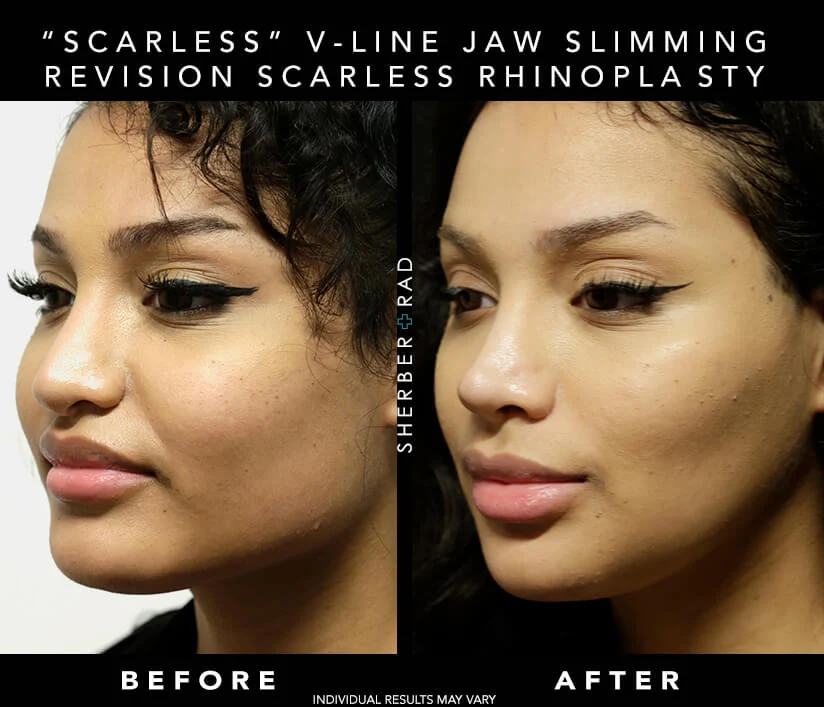 Chin Augmentation before and after photos by Sherber and Rad in Washington, DC Chin Augmentation before and after photos by Sherber and Rad in Washington, DC