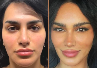 Canthoplasty before and after photos by Sherber and Rad in Washington