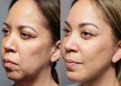 deep plane facelift before and after photos by sherber and rad in washington dc