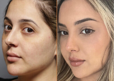 endoscopic brow lift before and after photos by sherber and rad in washington dc