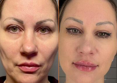 deep plane facelift before and after photos by sherber and rad in washington dc