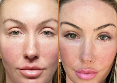 deep plane facelift before and after photos by sherber and rad in washington dc