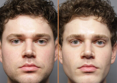 male facelift before and after photos by sherber and rad in washington dc