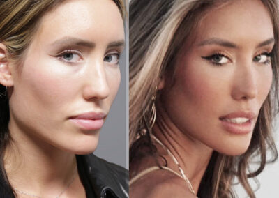 Jaw Reduction before and after photos by Sherber and Rad in Washington DC