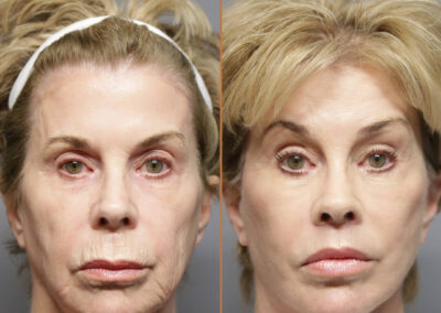 Facial Optimization before and after photos by Sherber and Rad in Washington