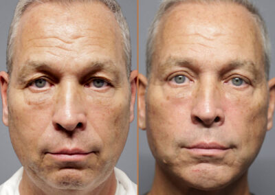 Male Facelift before and after photos by Sherber and Rad in Washington