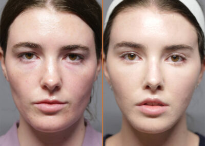Jaw Reduction before and after photos by Sherber and Rad in Washington DC