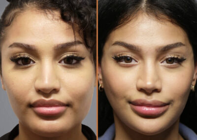 Jaw Reduction before and after photos by Sherber and Rad in Washington DC