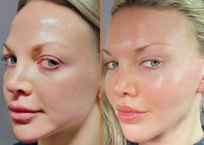 facelift before and after featured