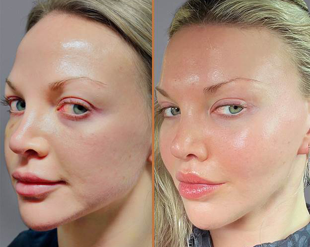 facelift before and after featured
