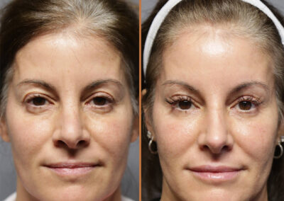 Brow Lift and Rhinoplasty before and after photos by Sherber and Rad in Washington DC