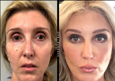 SMAS Facelift before and after photos by Sherber and Rad in Washington DC