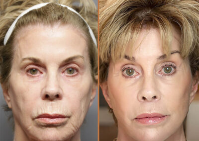 Deep Plane Facelift before and after photos by Sherber and Rad in Washington DC