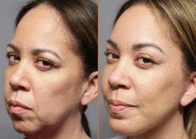 deep plane face before and after