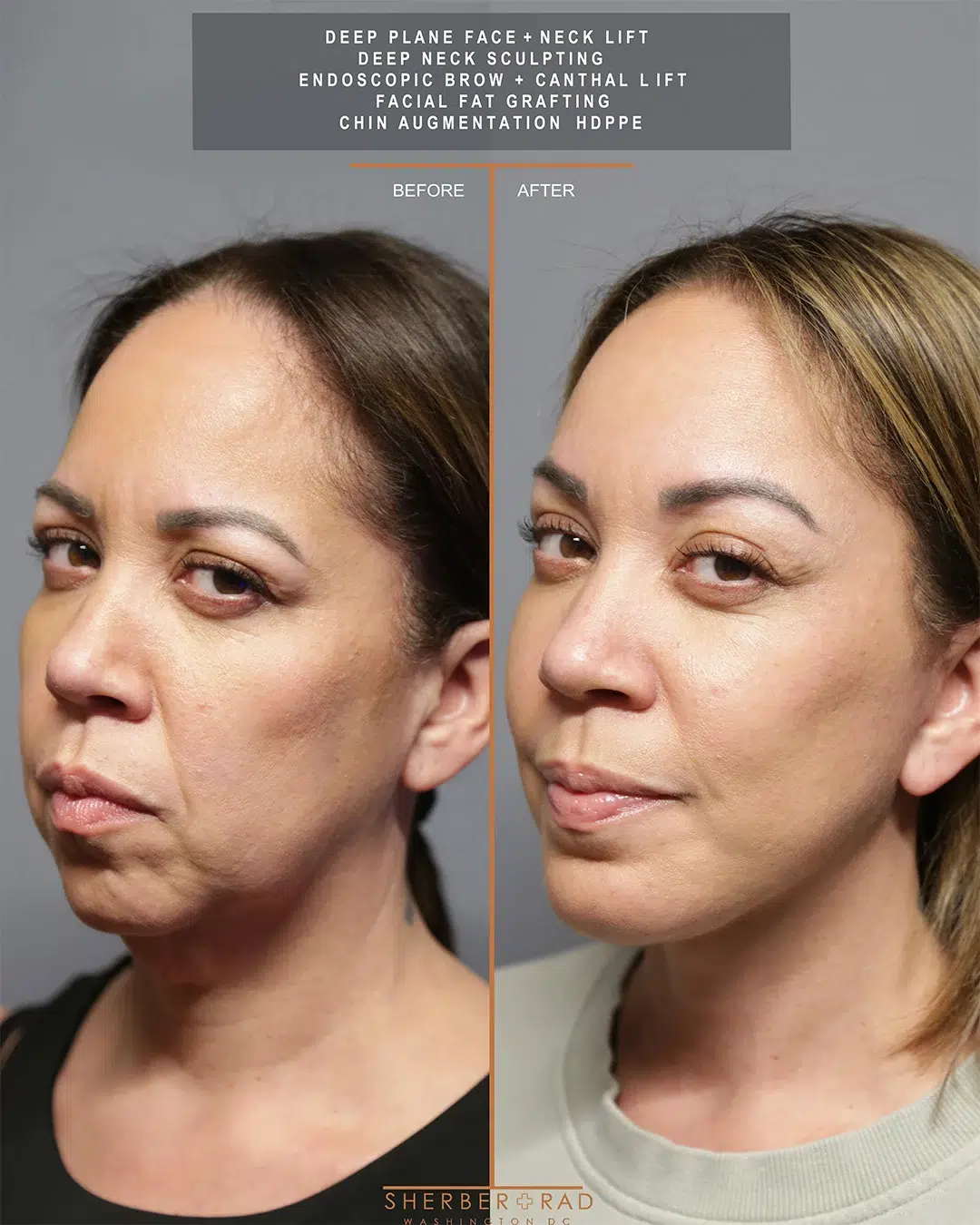deep plane face before and after