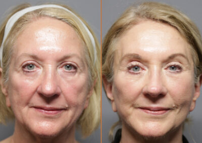 front view facelift browlift blepharoplasty fat grafting before and after photos by sherber and rad